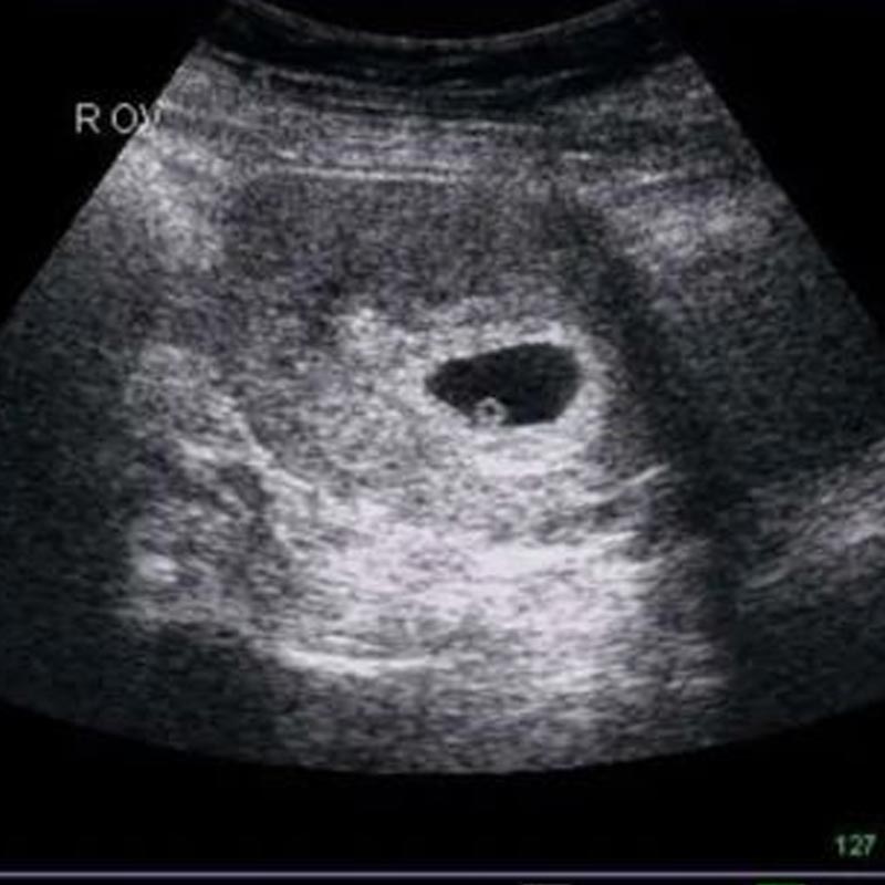 Chăm sóc sức khoẻ mẹ bầu tuần thứ 6 thai kỳ