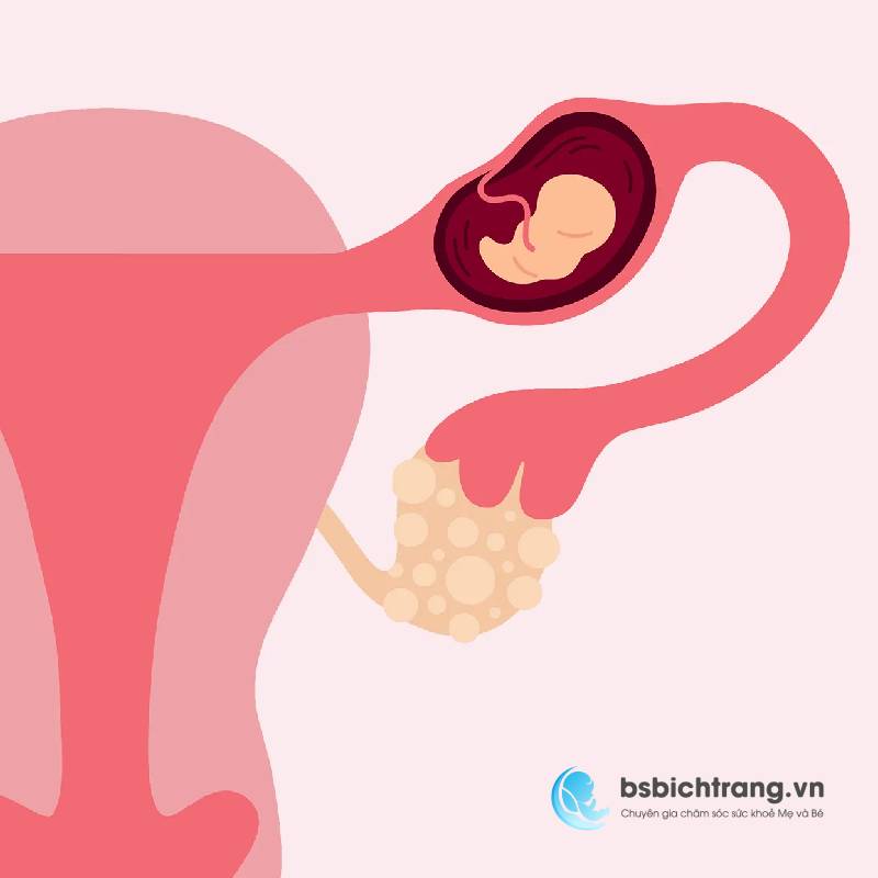 Thai ngoài tử cung có dấu hiệu gì? Chia sẻ từ Bs Bích Trang BMT – Chuyên gia chăm sóc sức khỏe Mẹ và Bé